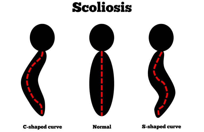 Anchorage, AK scoliosis treatment